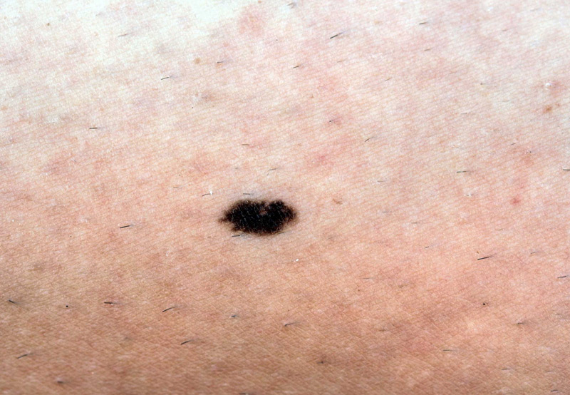 Close-up-of-skin-cancer